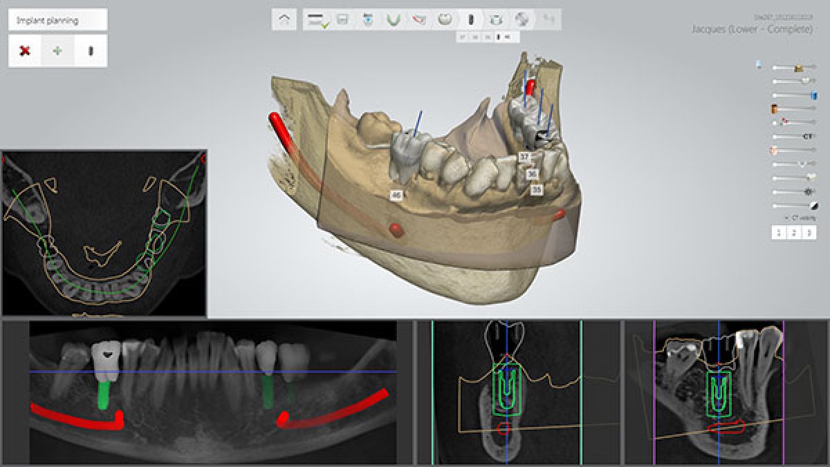 3Shape launches Implant Studio™ for implant planning and surgical guide design