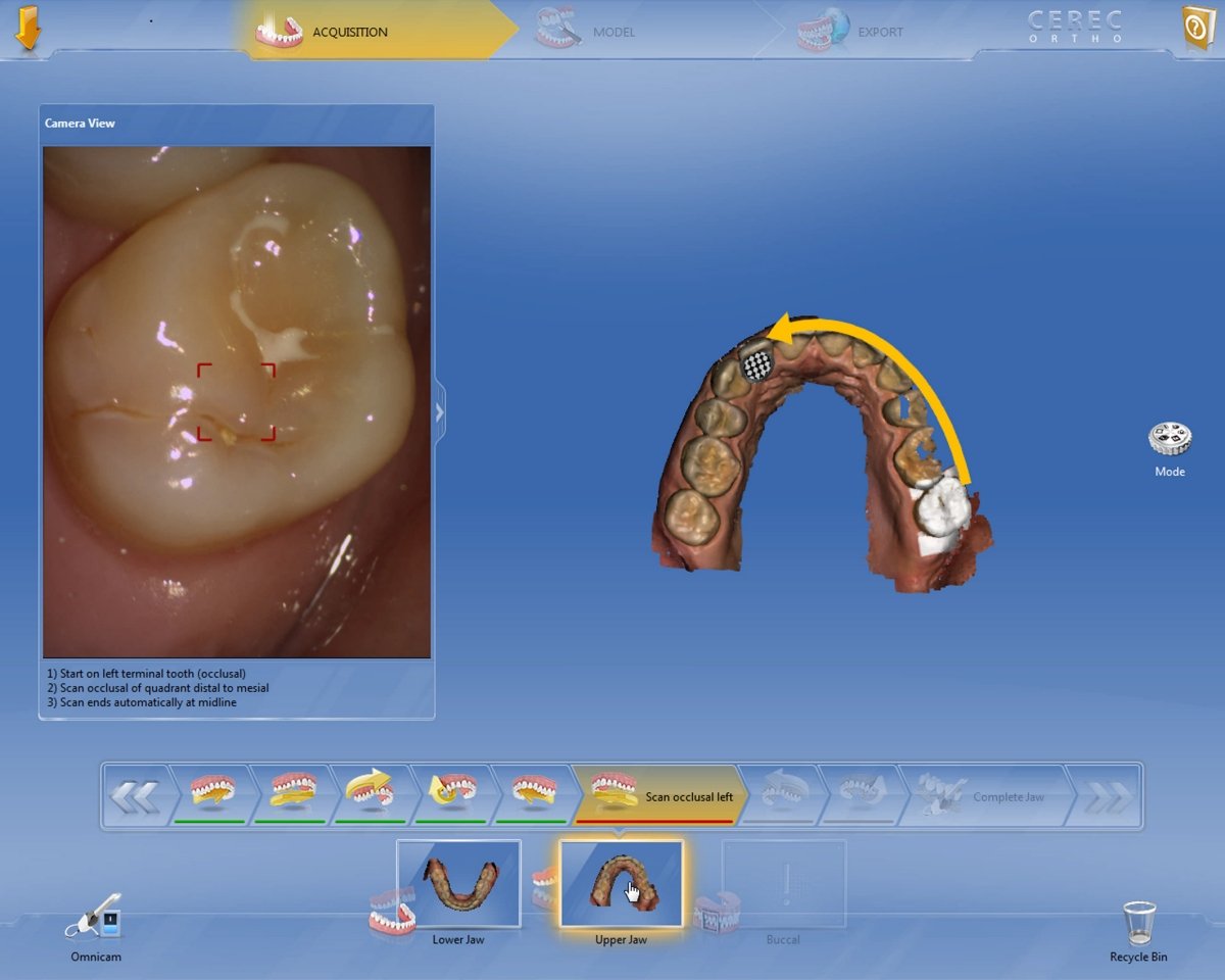 CEREC Ortho SW : Digital impressions for orthodontic indications