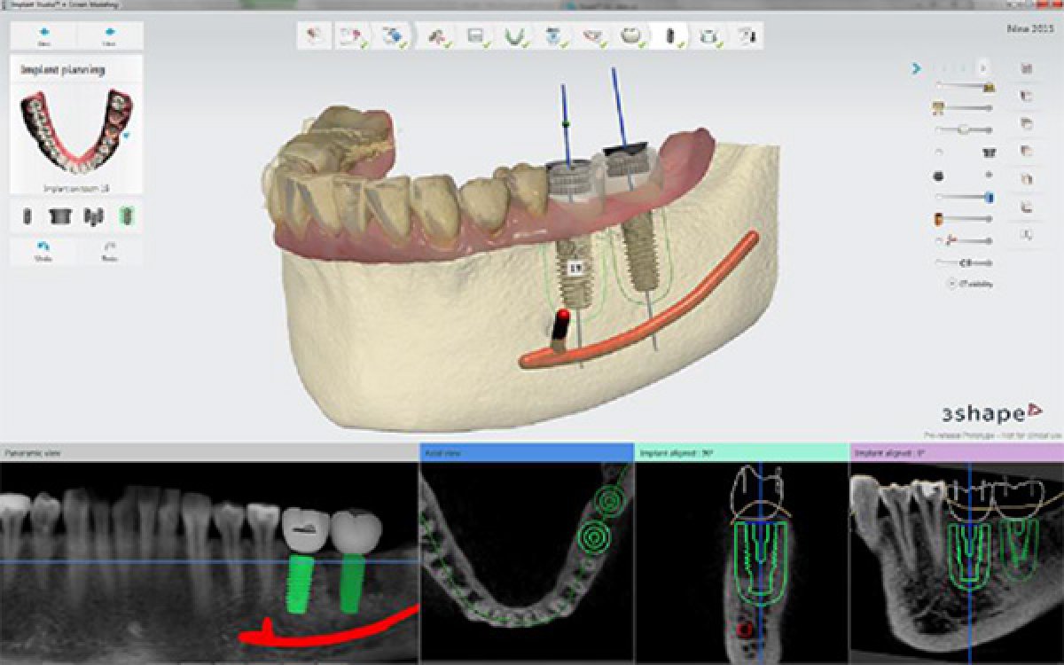 Implant Studio™ 2015 software 
