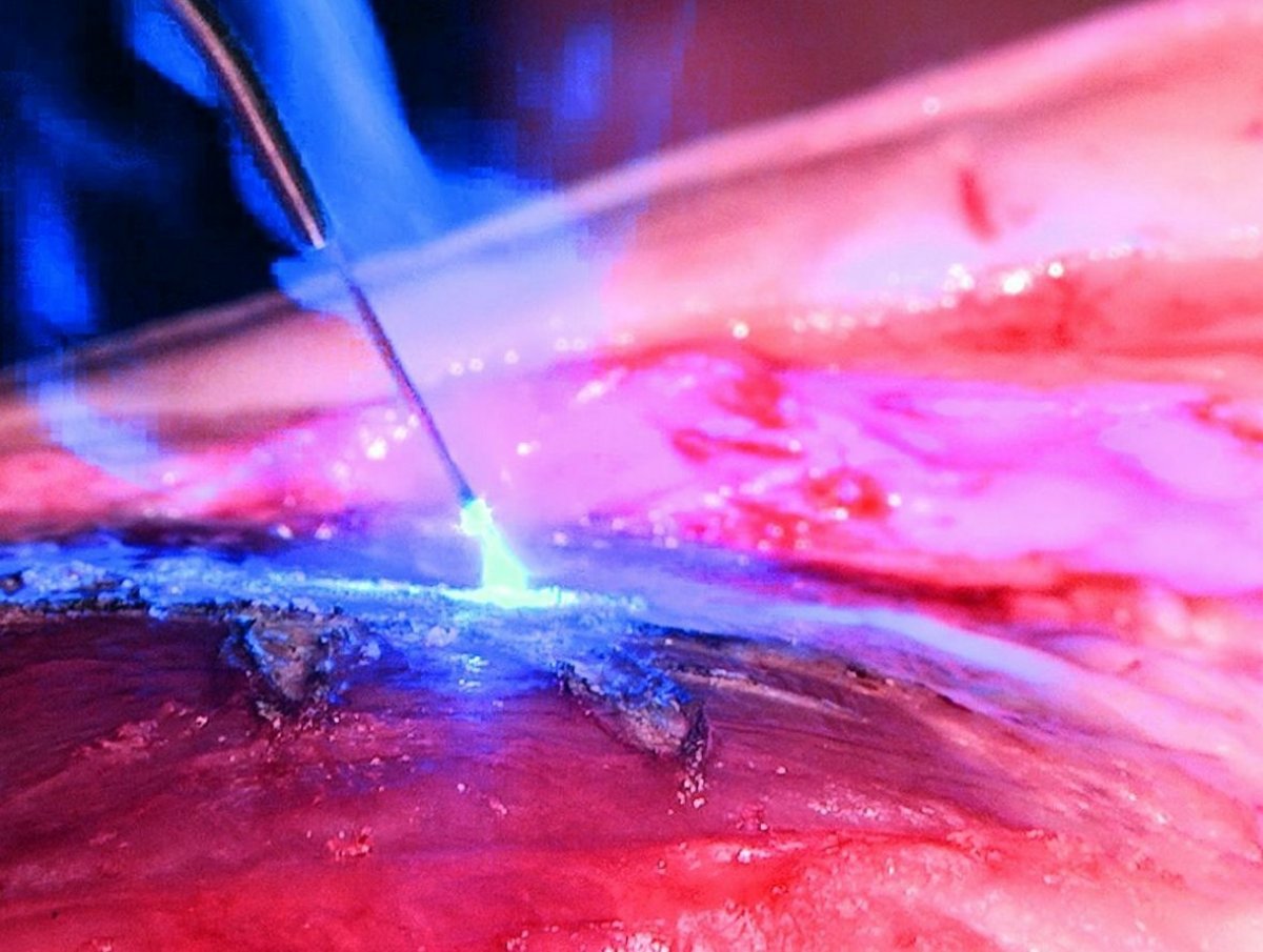 SiroLaser Blue : Surgical Precision in Blue