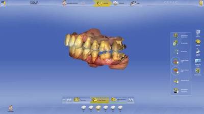 Sirona combines innovation and ease of use with the new CEREC 4.3 dental software